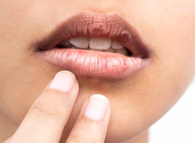 Cara Menghilangkan Hitam di Pinggir Bibir: Solusi Alami dan Efektif