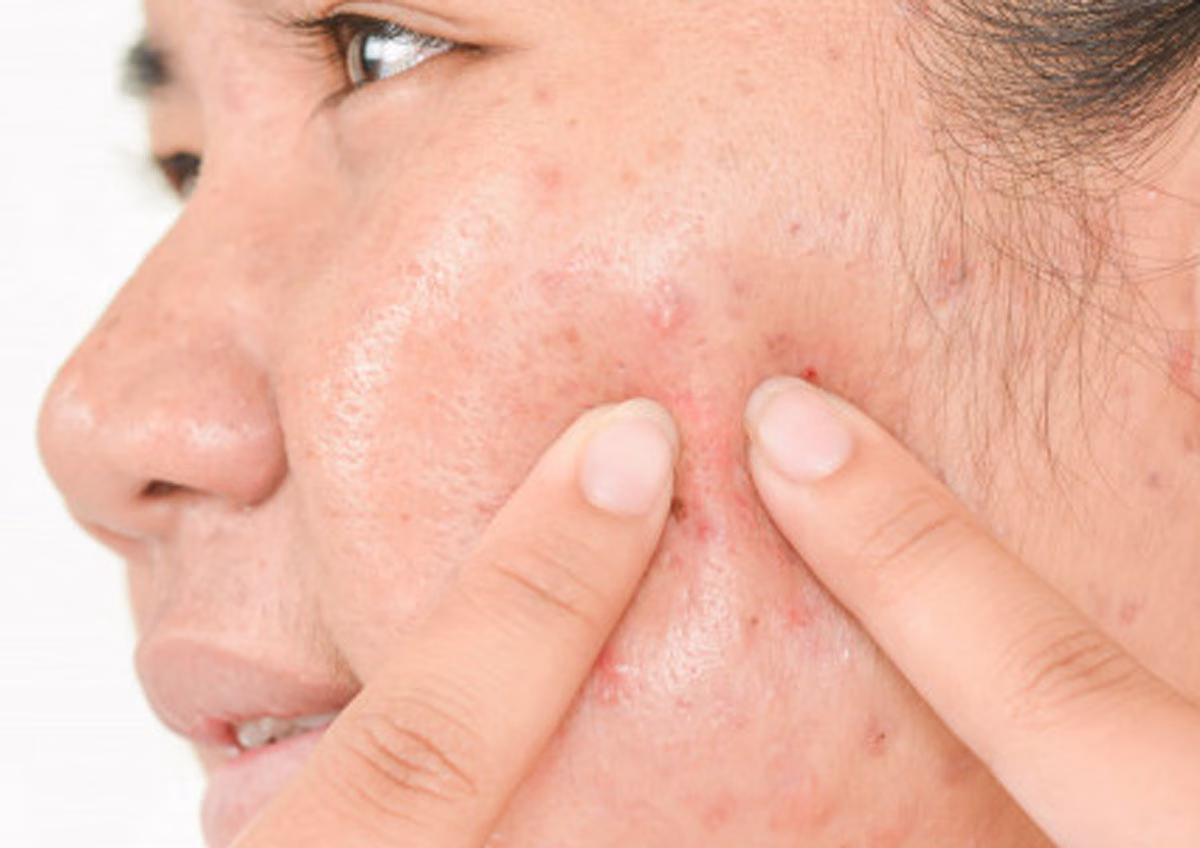 Mempercepat Purging: Rahasia Kulit Sehat Lebih Cepat