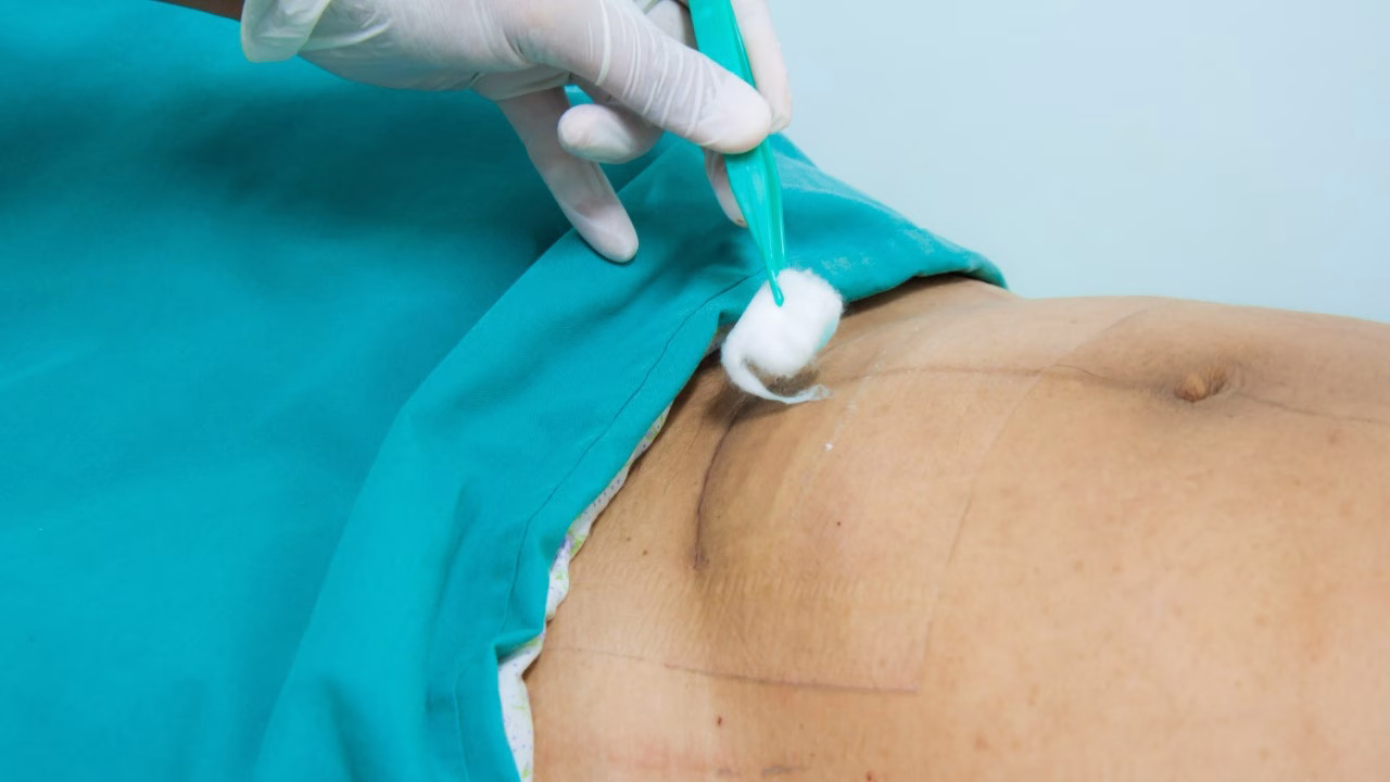 salep luka operasi caesar