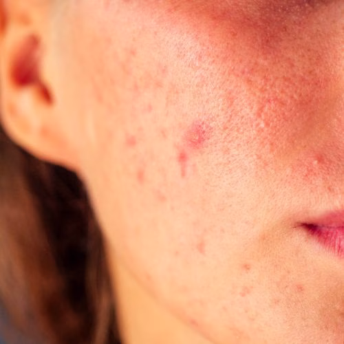 skincare untuk kulit sensitif