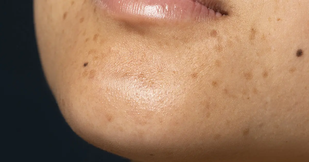 bintik hitam di wajah seperti tahi lalat