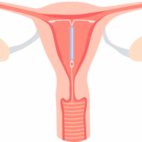 ciri-ciri hamil saat kb iud
