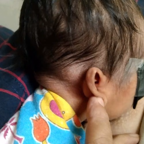 benjolan di belakang kepala bayi