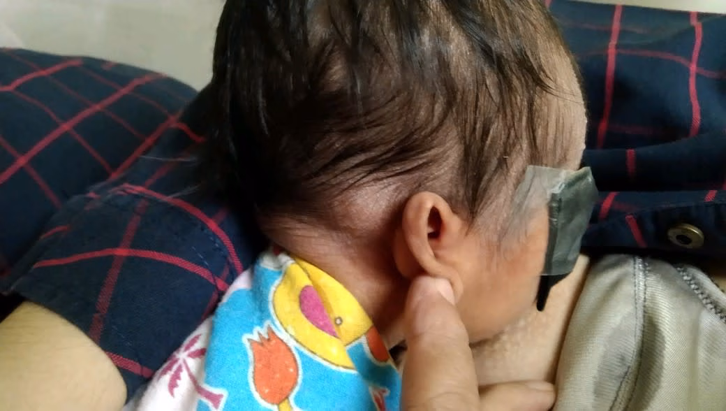 benjolan di belakang kepala bayi