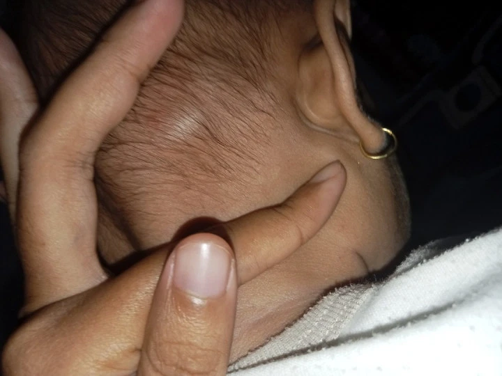 benjolan di belakang kepala bayi