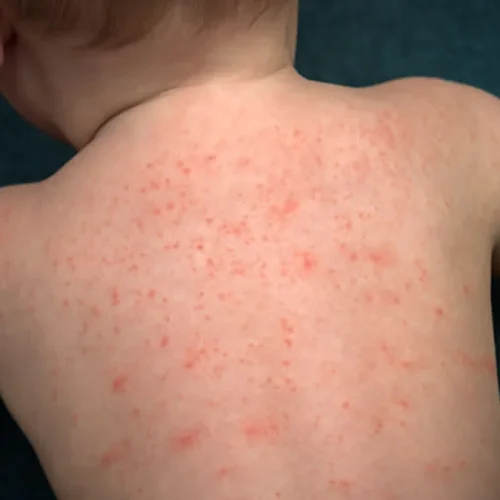 bentol berair pada kulit bayi