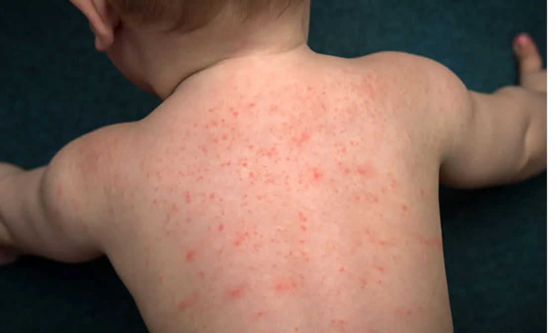 bentol berair pada kulit bayi