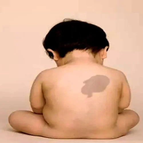 cara menghilangkan tanda lahir