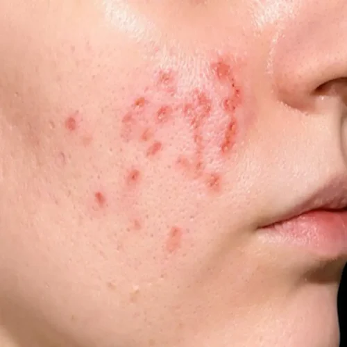 cara mengatasi jerawat membandel