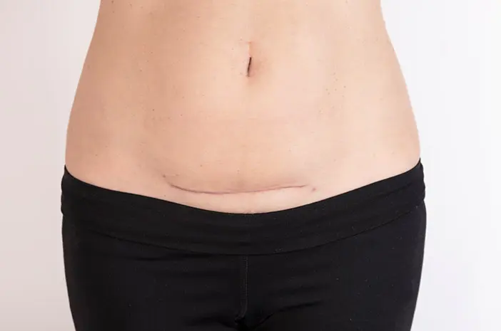 keloid bekas luka sesar yg bagus