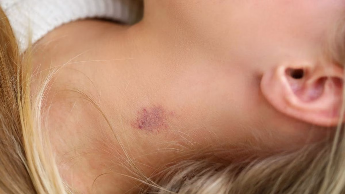 manfaat cupang di leher