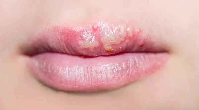 bibir bentol kecil